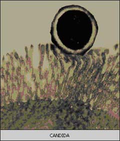 candidiasis2